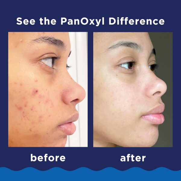 PanOxyl Acne Foaming Wash Benzoyl Peroxide 10% Maximum Strength Antimicrobial, 5.5 Oz - Image 7